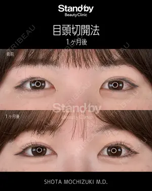 before image