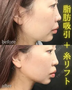 before image