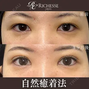 before image