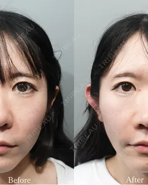 before image