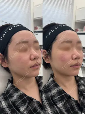 0 days after image