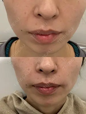 0 days after image