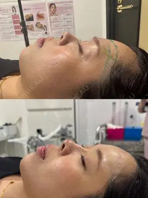 0 days after image