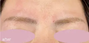 0 days after image