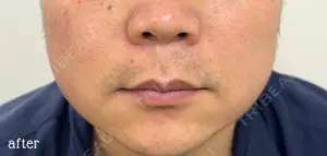 0 days after image