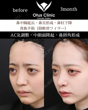 90 days after image