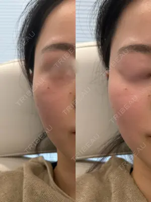 0 days after image