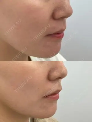 before image