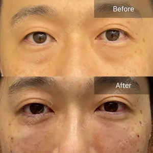 0 days after image