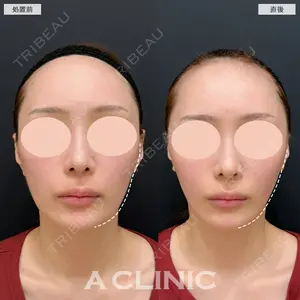 0 days after image