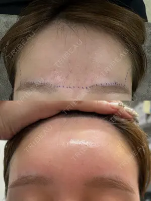 1 days after image