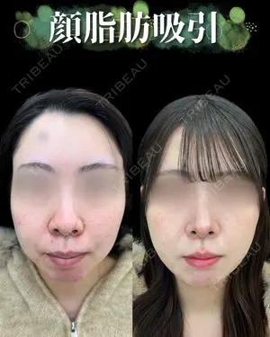 90 days after image
