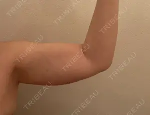 1 days after image