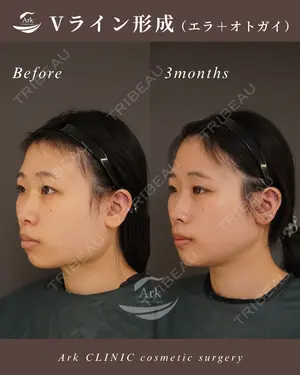 90 days after image