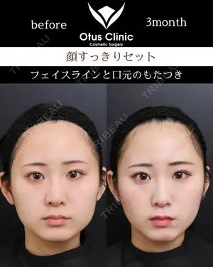 90 days after image