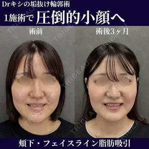 90 days after image