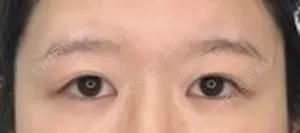 before image