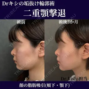 90 days after image