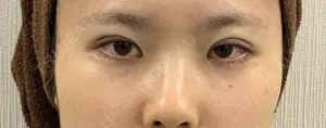 1 days after image