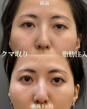 90 days after image