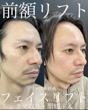 before image