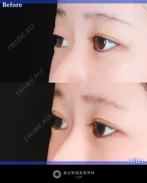 before image