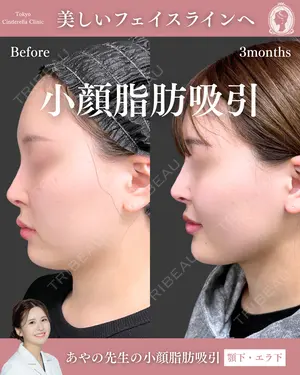 90 days after image