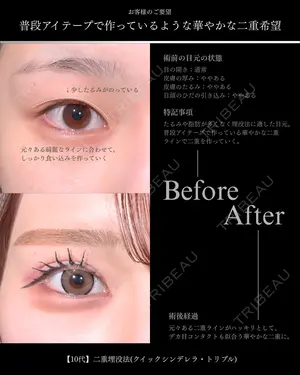 before image