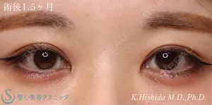 45 days after image
