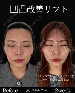 14 days after image