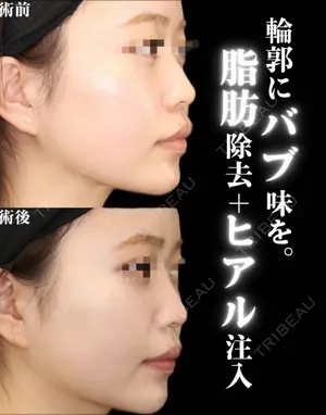 before image