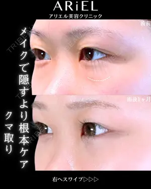 before image