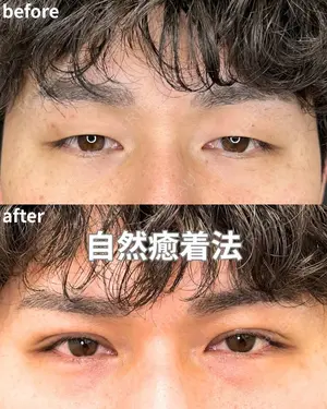 before image