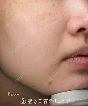 before image