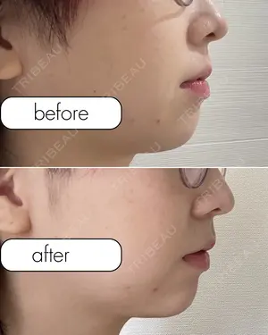 0 days after image