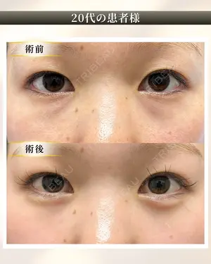 before image