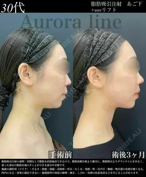 before image