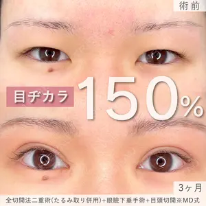 90 days after image