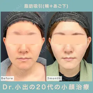 90 days after image