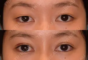 before image