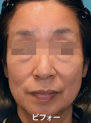 before image