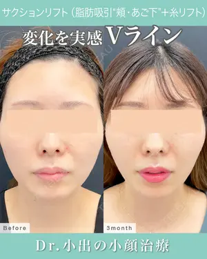 90 days after image