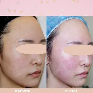 1 days after image