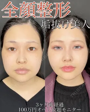 90 days after image