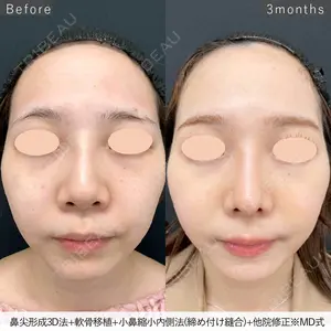 90 days after image