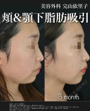 90 days after image