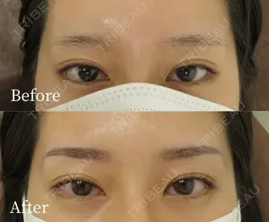 before image