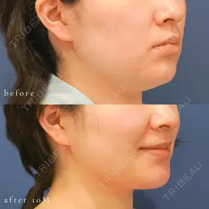 before image