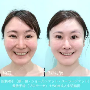 90 days after image