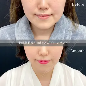 90 days after image